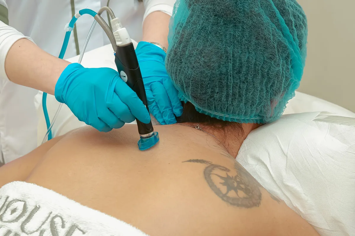 Practitioner in gloves using a laser handpiece on a tattoo on a client's back